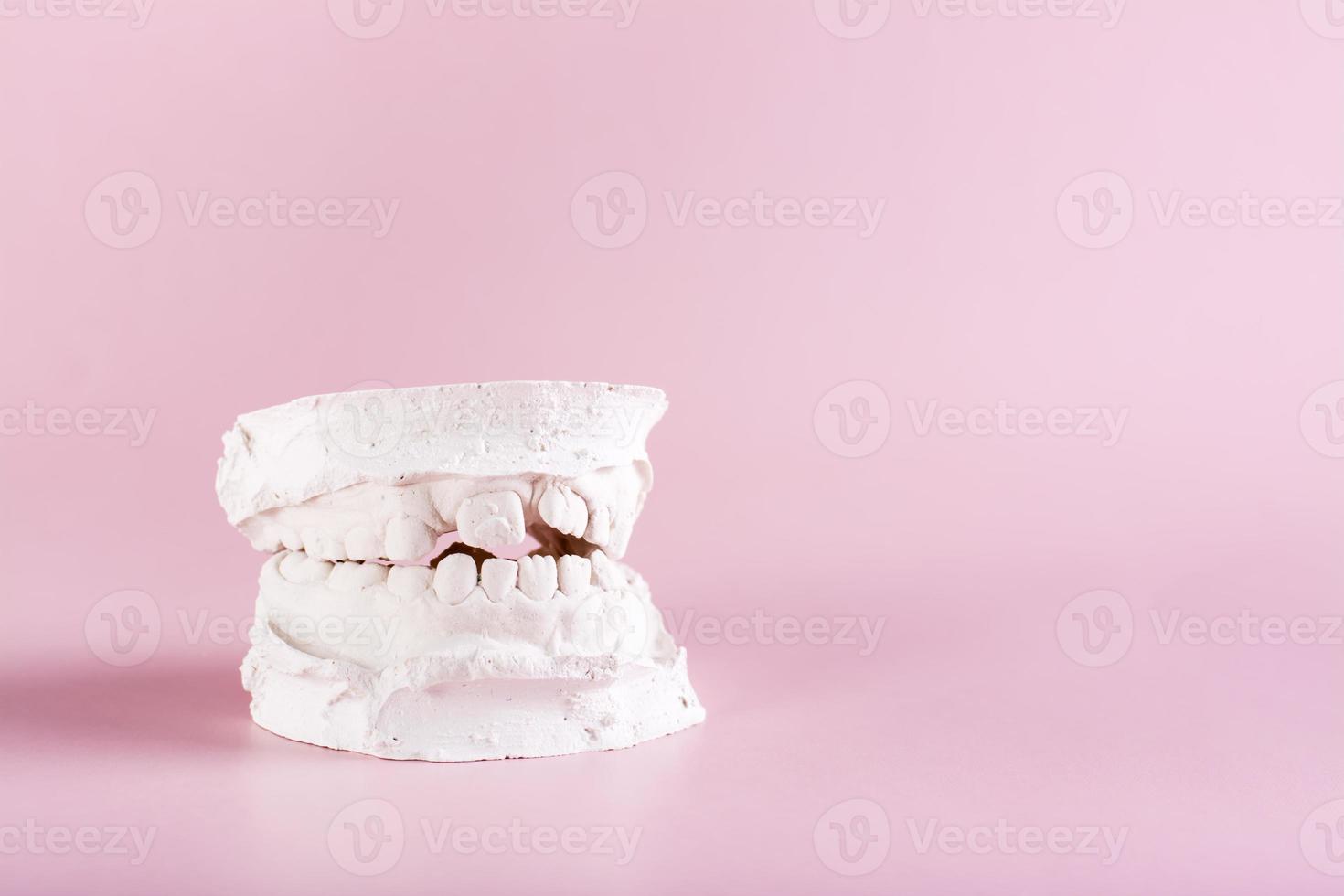 dental plåster kasta av krokig barns tänder på en rosa bakgrund foto