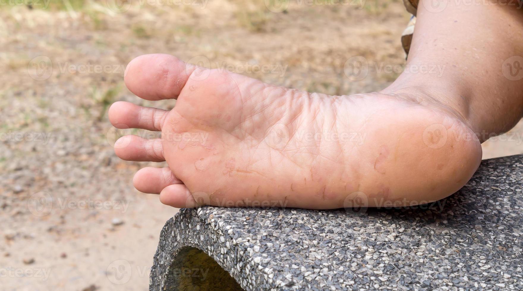 kvinna lidande från fot öm orsakade förbi idrottarens fot, patient lidande från svår fot hud sjukdom, stänga upp Foto av fot sjukdom, begrepp av ohälsosam mänsklig fot