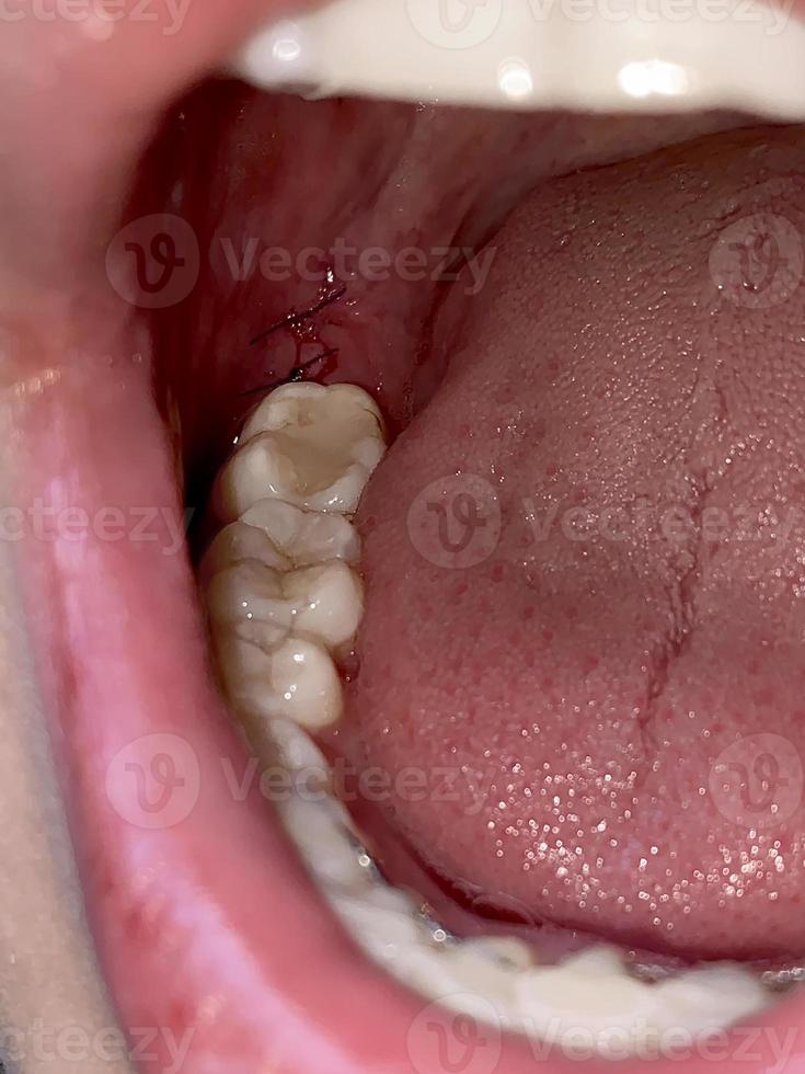 mjuk fokus. suturer efter visdom tand extraktion, dental kirurgi. oral hygien foto