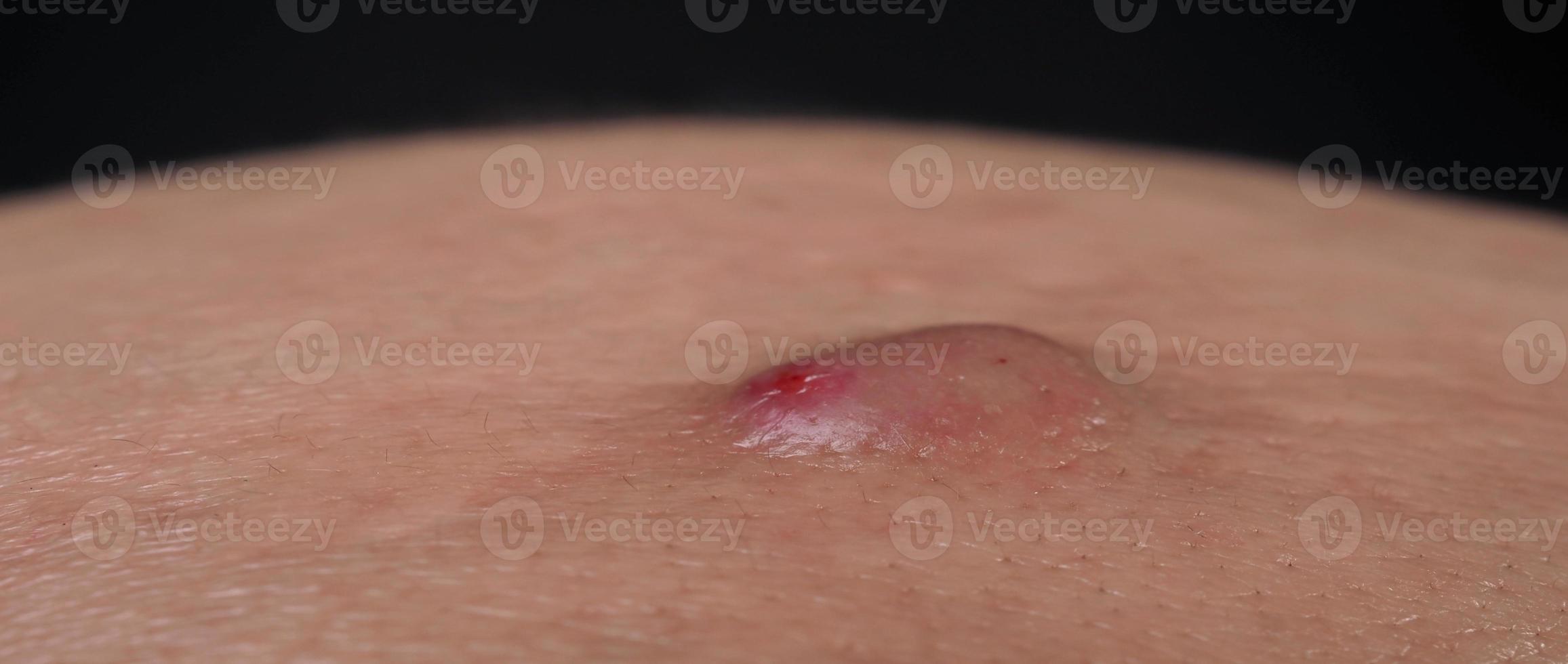 stor acne cysta böld eller ulcus svullen område inom ansikte hud vävnad. foto