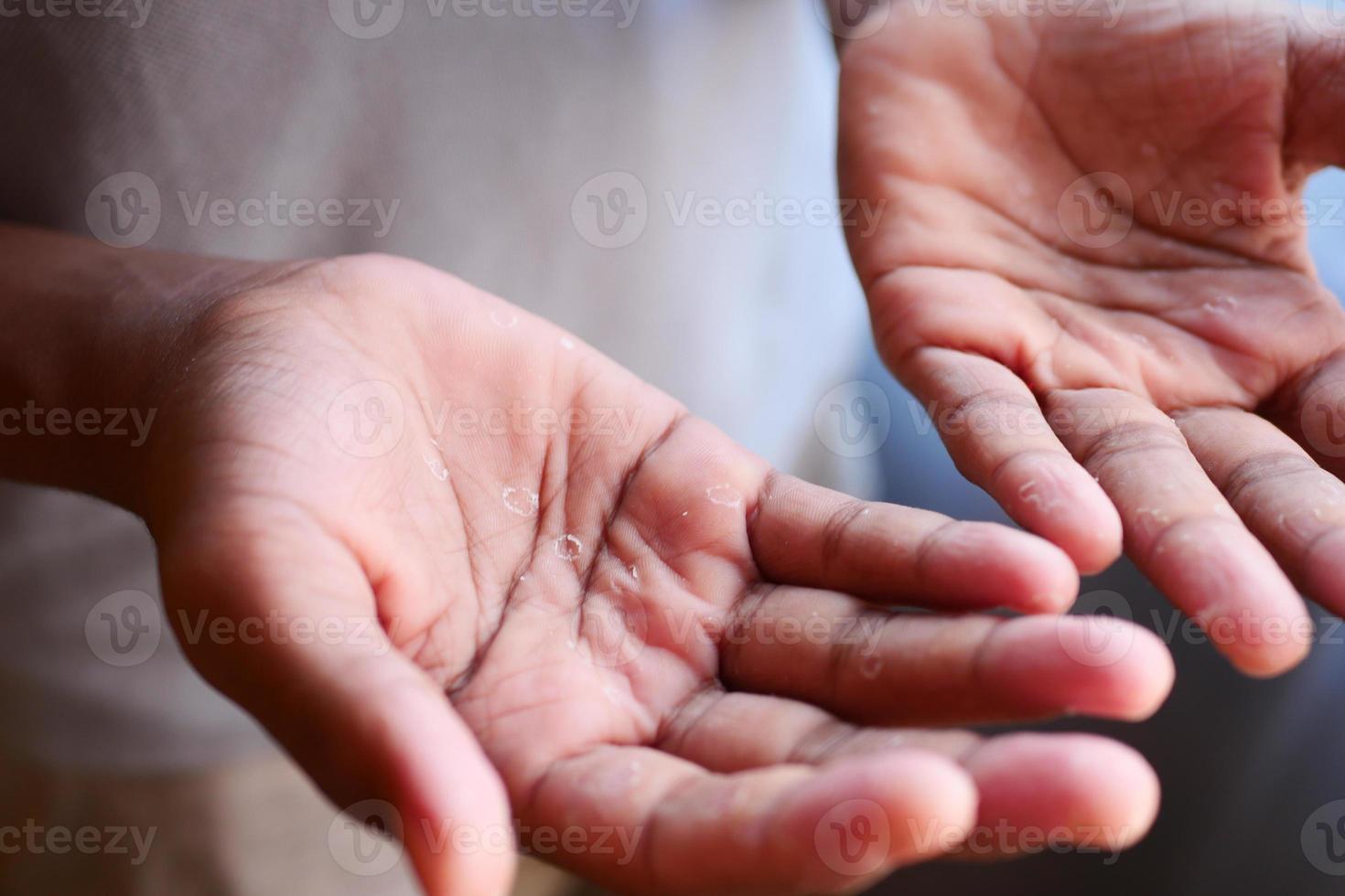 stänga upp av torr knäckt hud av en herr- hand foto