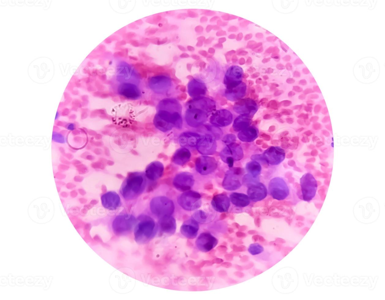 mikrofotografi av bra nål strävan cytologi av en lung- liten knöl som visar adenokarcinom, en typ av icke små cell carcinom. foto