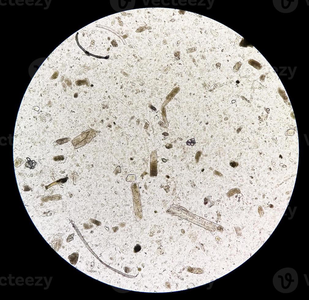 mikroskopisk urin undersökning som visar grynig kasta, en tecken av många typer av njure sjukdomar. foto