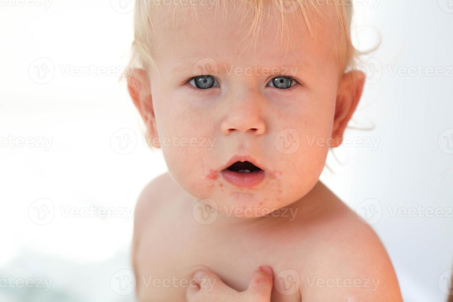 porträtt av en bebis med en utslag nära de mun. enterovirus, allergi i en unge. foto