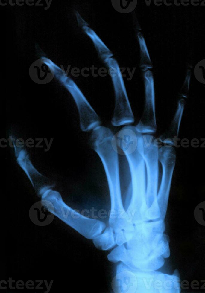 röntgen hand, medicinsk bild. foto