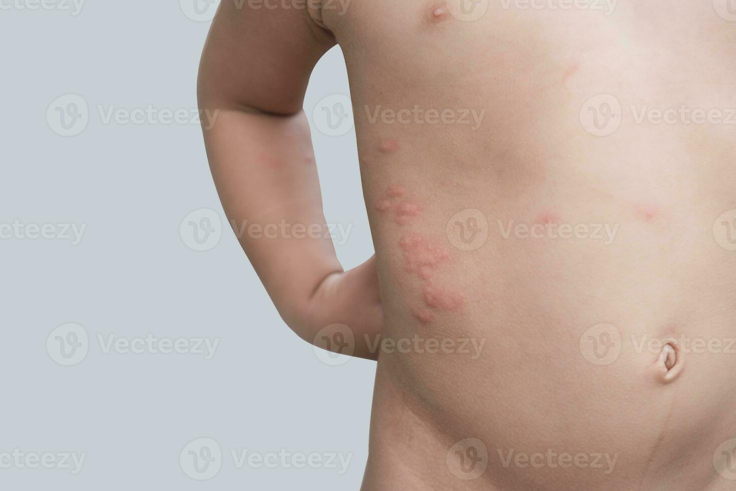 pojke med flera olika och insekt biter på kropp foto