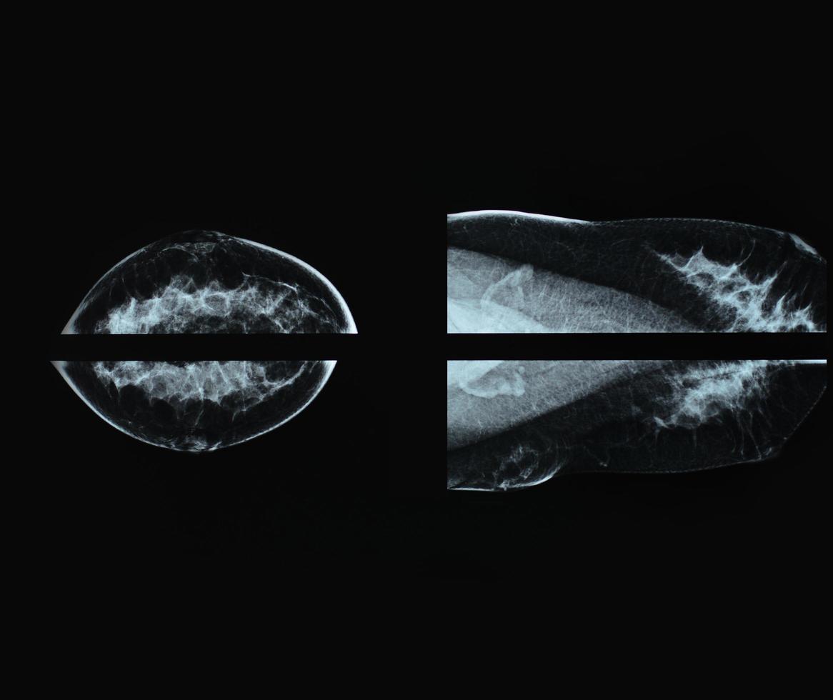 mammografi röntgenfilmbild för bröstcancer foto