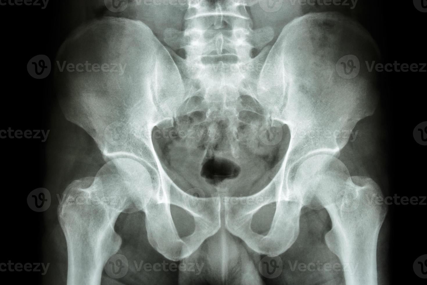 filma röntgenmänniskans bäcken och höftleder foto