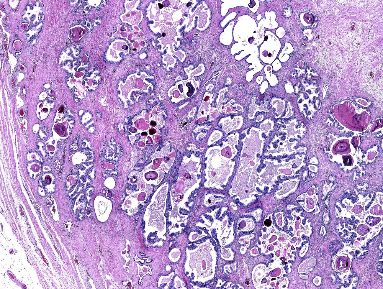 mänsklig prostata corpora amylacea foto