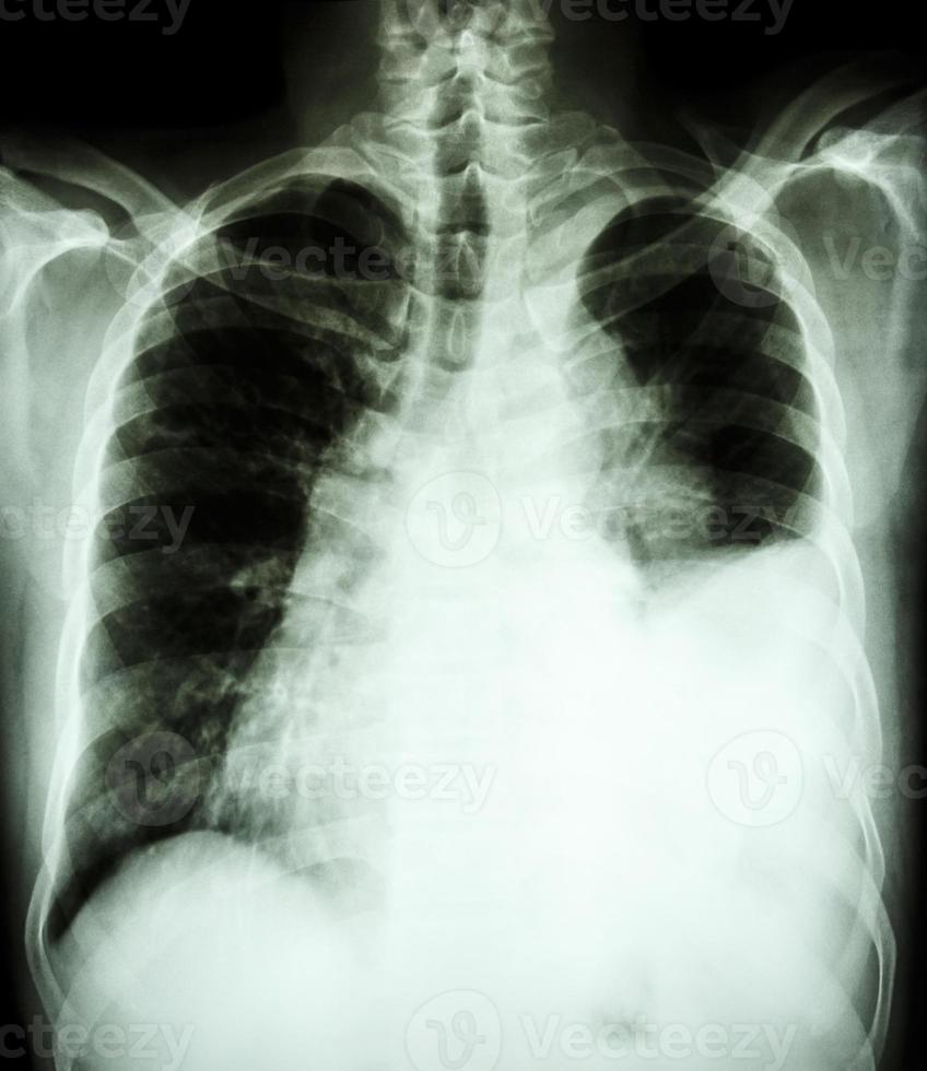 film bröst röntgenbild upprätt visar pleural effusion vid vänster lunga på grund av lungcancer foto