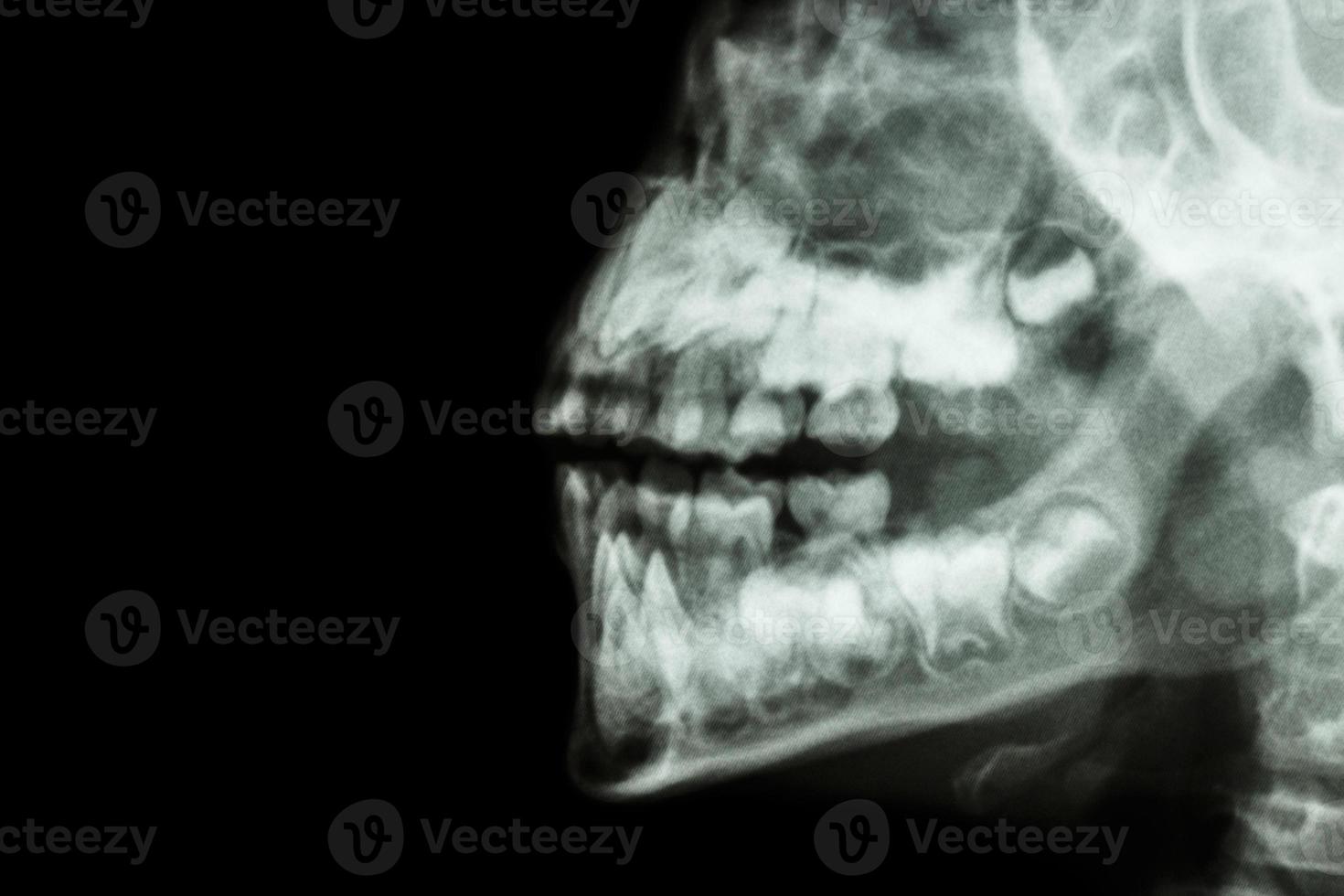 filma röntgenmänniskans käke och tänder och tomt område på vänster sida foto