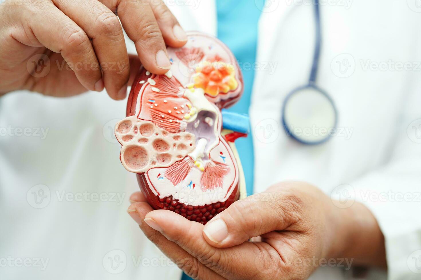 kronisk njure sjukdom, läkare innehav modell för behandling urin- systemet, urologi, beräknad glomerulär filtrering Betygsätta egfr. foto