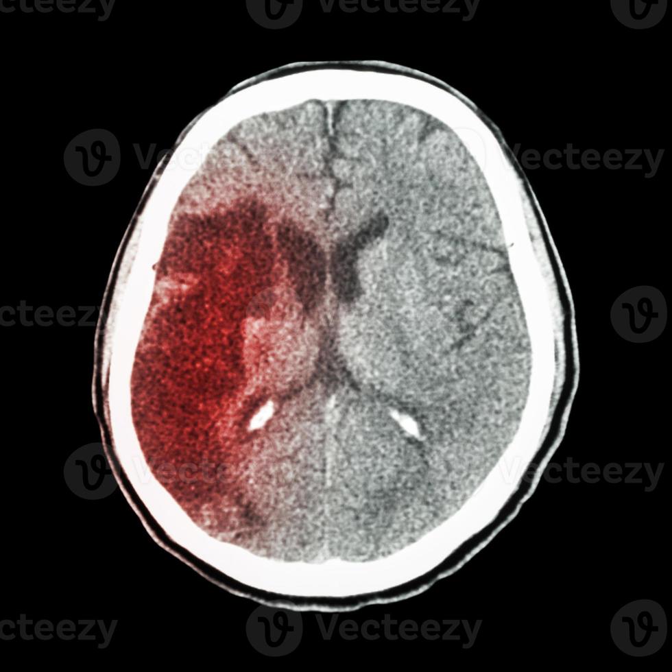 ct hjärnan visar ischemisk stroke hypodensitet vid höger frontal parietal område foto