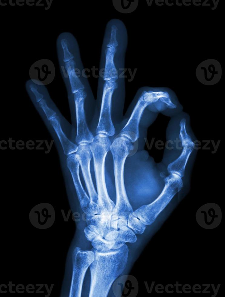 röntgenhand med ok-symbolen foto