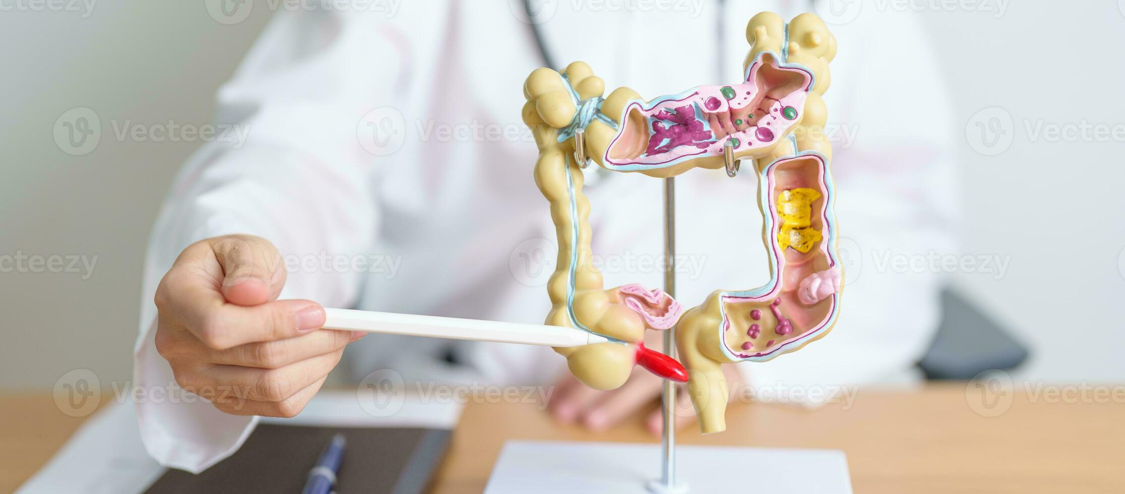 läkare med mänsklig kolon anatomi modell. kolon sjukdom, stor inälvor, kolorektal cancer, ulcerös kolit, divertikulit, irritabel skål syndrom, matsmältnings systemet och hälsa begrepp foto