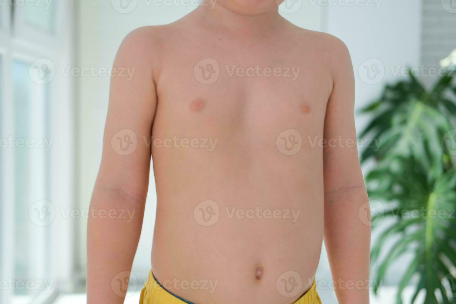 en barn med en pektus utgrävning. engelska sjukan är en Följd av vitamin d brist. foto