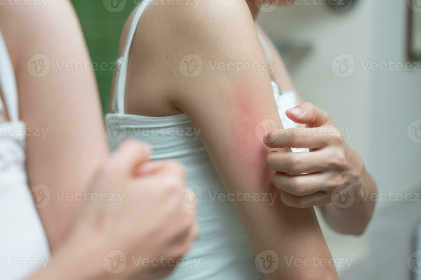 hud problem och skönhet. ung kvinna repa kropp har kliande hud från hud allergisk, steroid allergi, känslig hud, röd från solbränna, kemisk allergi, utslag, insekt biter, seborroiskt dermatit. foto