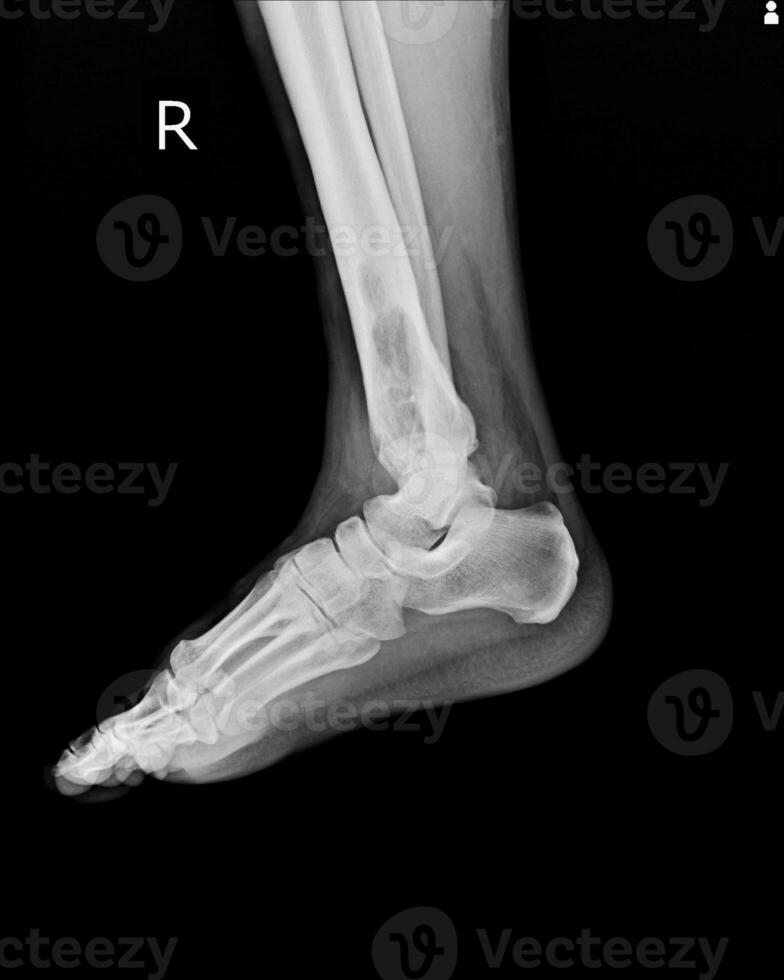 röntgen rt.ankel upptäckt intramedullär osterolytisk lesion av rätt distal skenben foto