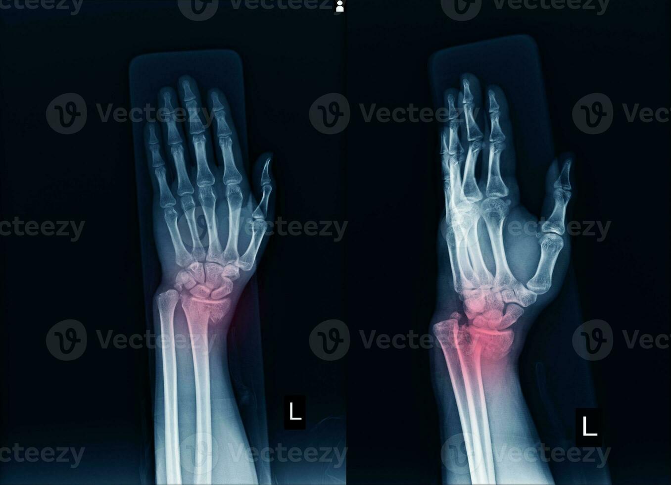 röntgen vänster handled gemensam fraktur med förflyttning distal slutet vänster radie. foto