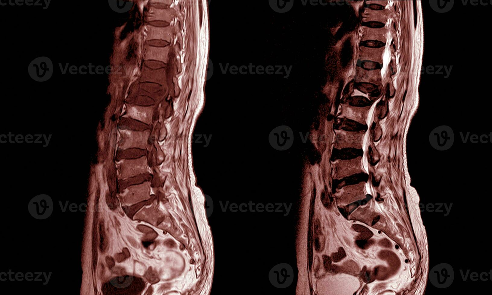 mri av de lumbosakral ryggrad. foto