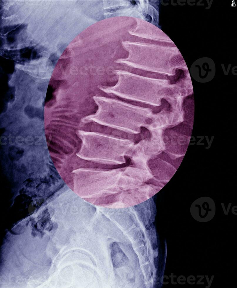 länd- ryggrad röntgen visa sporre av vertebral kropp. foto