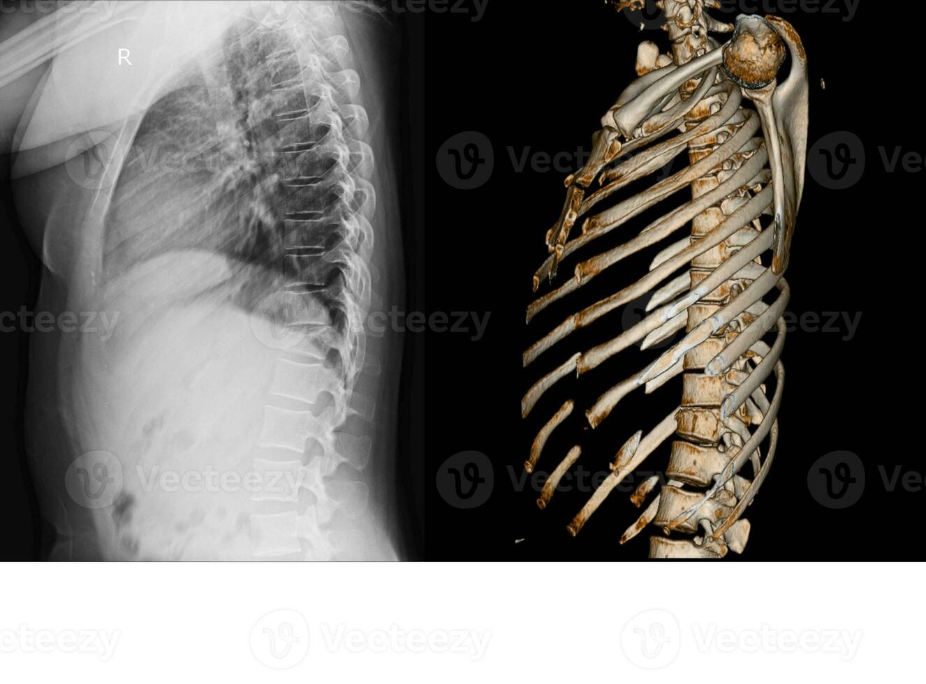 röntgen och ct skanna bröstkorg ryggrad foto