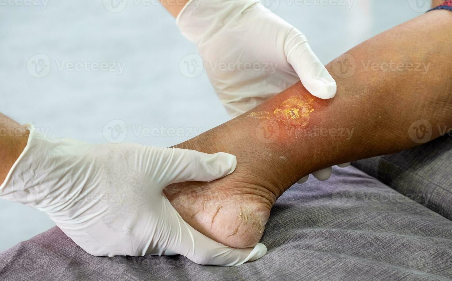 läkare bär en vit hygienisk handske och innehav ett äldre kvinnas ben till kolla upp för kallbrand på grund av till diabetes. begrepp av sjukvård och yrkes hälsa foto