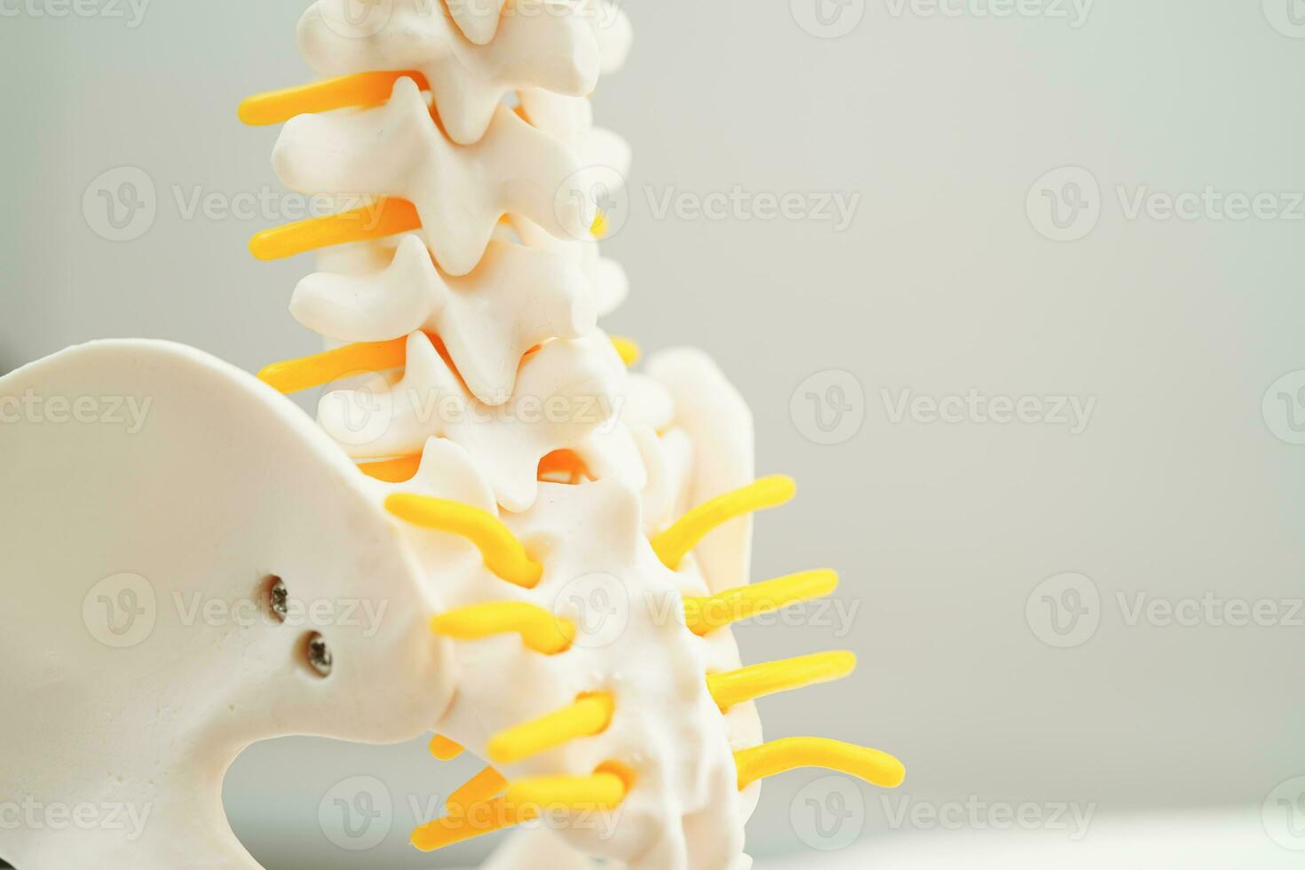 spinal nerv och ben, länd- ryggrad fördrivna herniated skiva fragment, modell för behandling medicinsk i de ortopedisk avdelning. foto