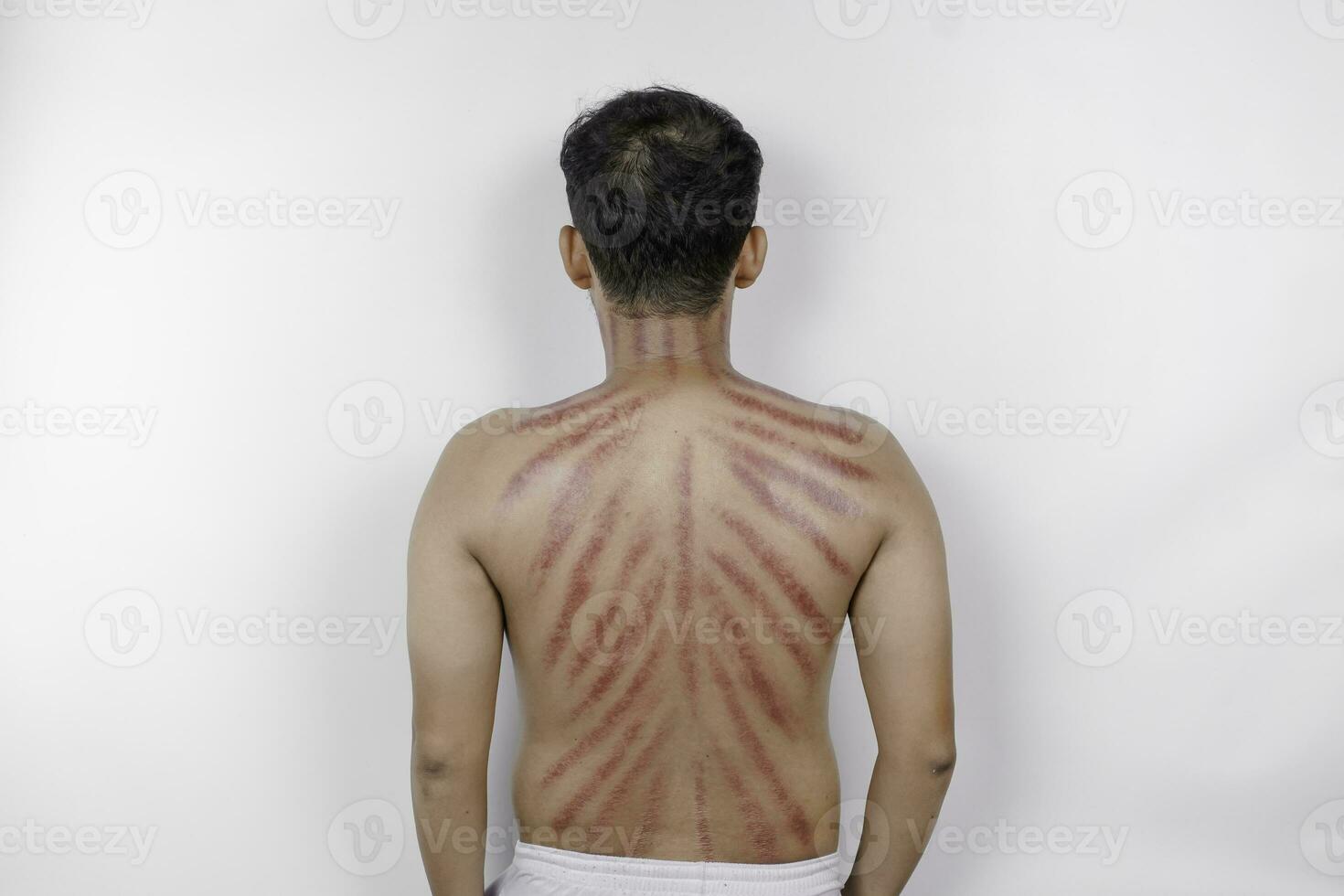 röd märken från skrapor mynt på en mannens tillbaka. kerokan är en sätt av traditionell javanese kultur medicinsk behandling till behandla symptom av förkylningar i indonesien foto