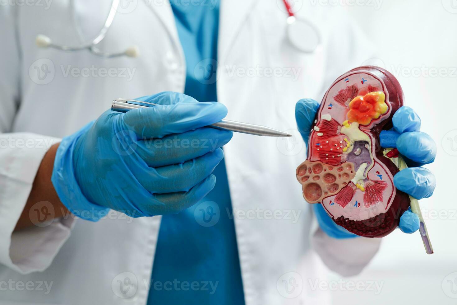 kronisk njure sjukdom, läkare innehav modell för behandling urin- systemet, urologi, beräknad glomerulär filtrering Betygsätta egfr. foto