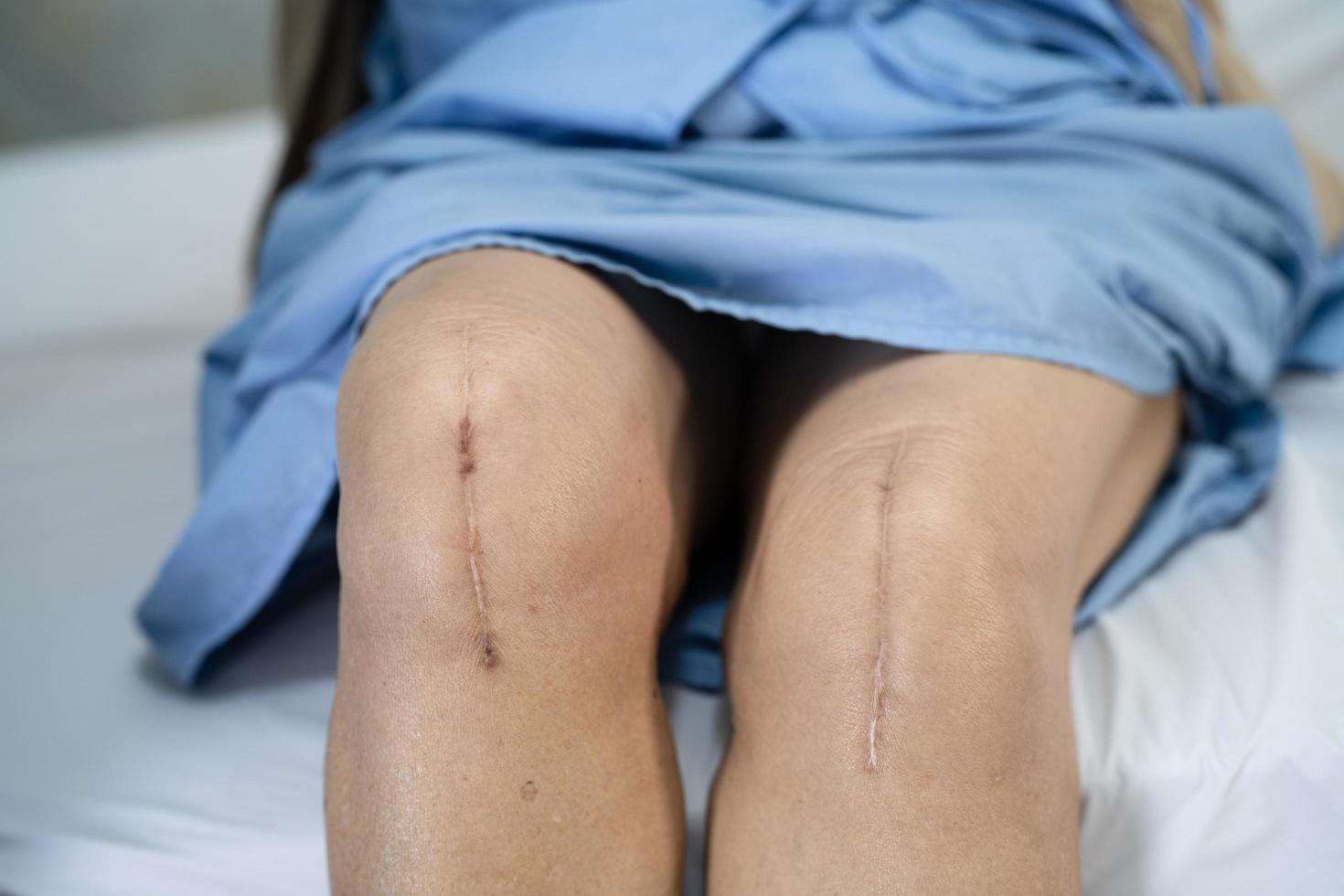 asiatisk senior eller äldre gammal damkvinnapatient visar hennes ärr kirurgisk total knäledsersättning sutur såroperation artroplastik på sängen i vårdavdelningen, hälsosamt starkt medicinskt koncept. foto