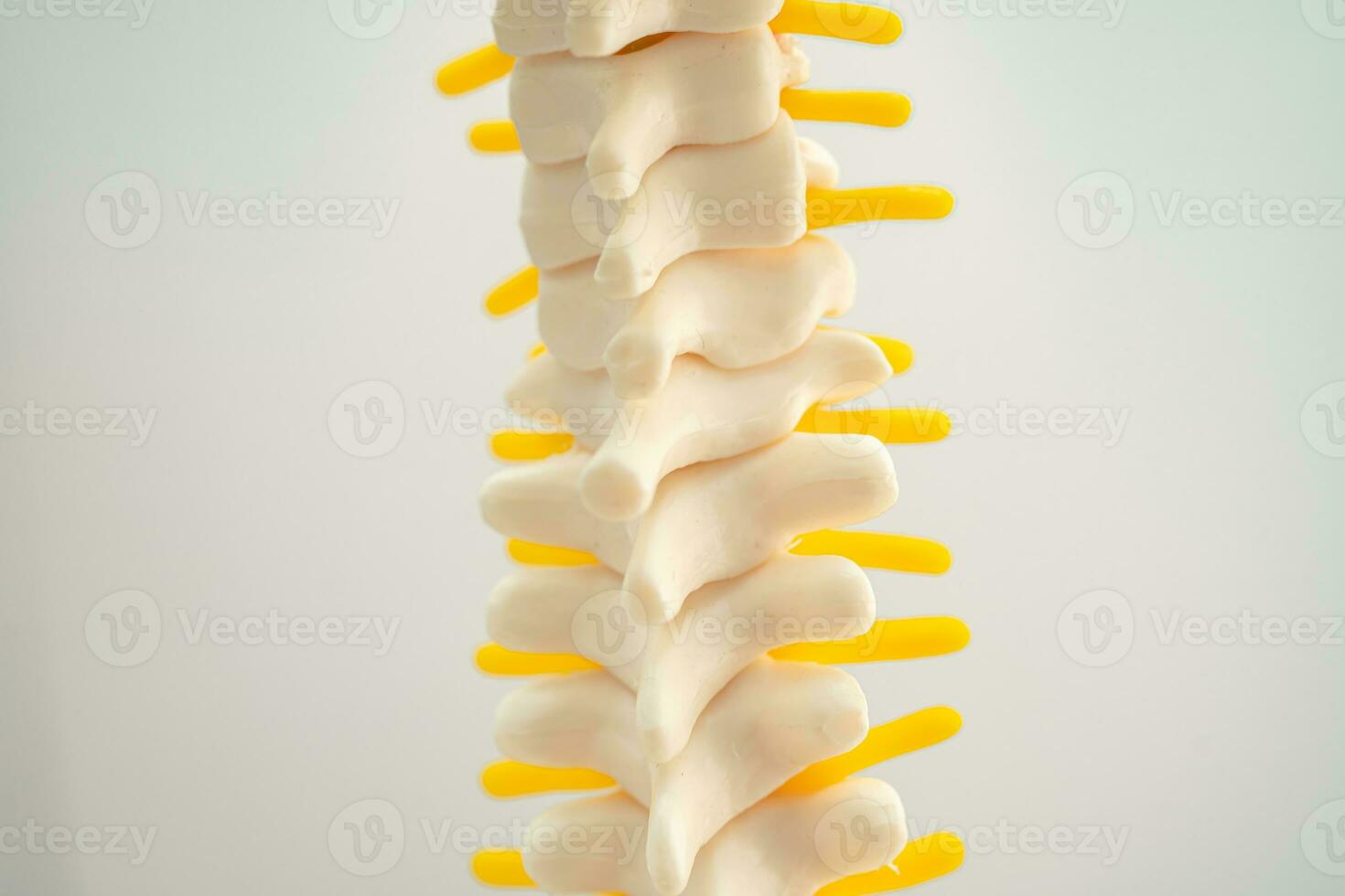 länd- ryggrad fördrivna herniated skiva fragment, spinal nerv och ben. modell för behandling medicinsk i de ortopedisk avdelning. foto