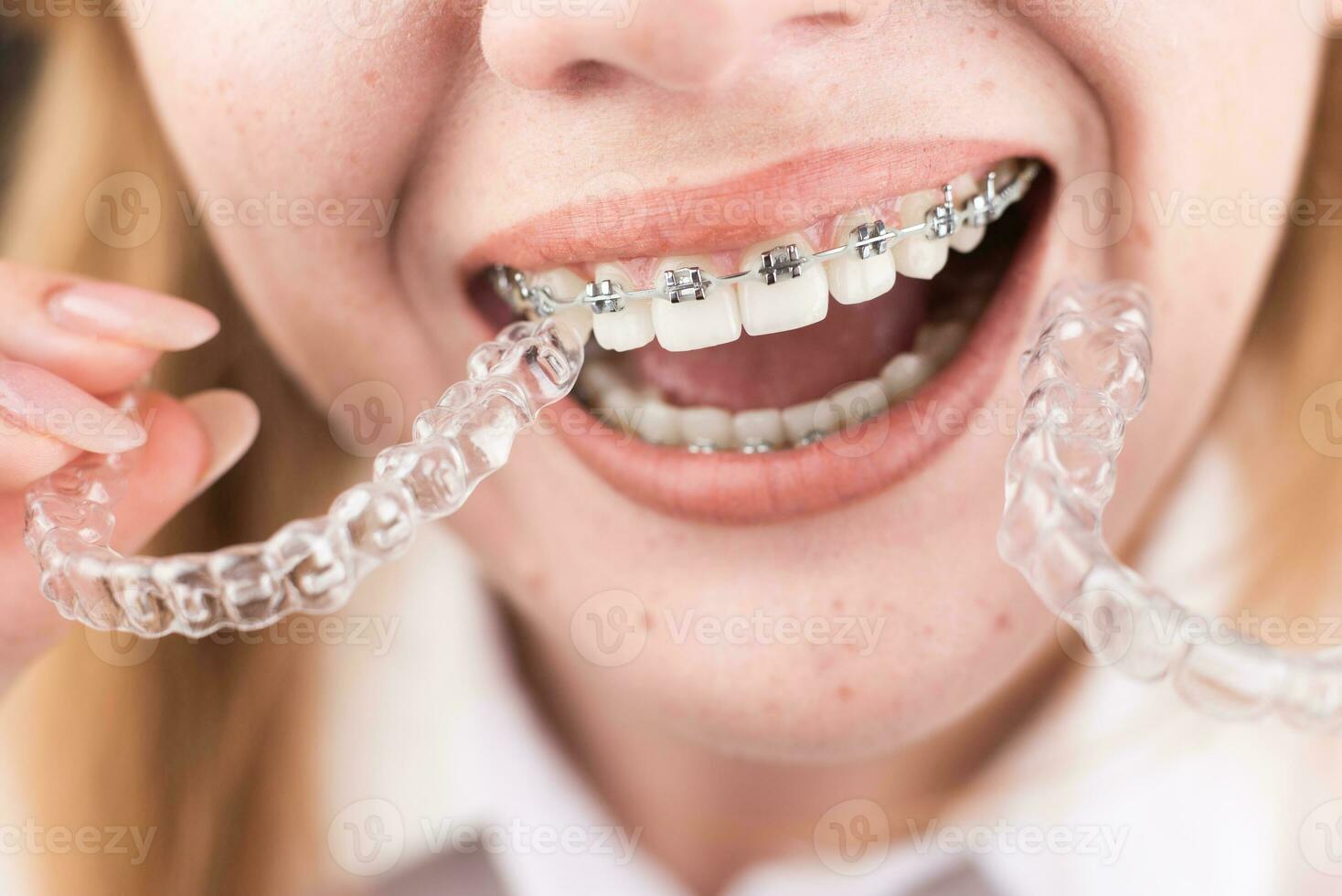 dental omsorg.ler flicka med tandställning på henne tänder innehar inriktare i henne händer och visar de skillnad mellan dem foto