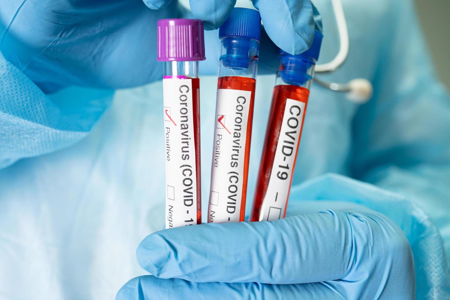 positivt blodinfektionsprov i provrör för covid-19 coronavirus foto
