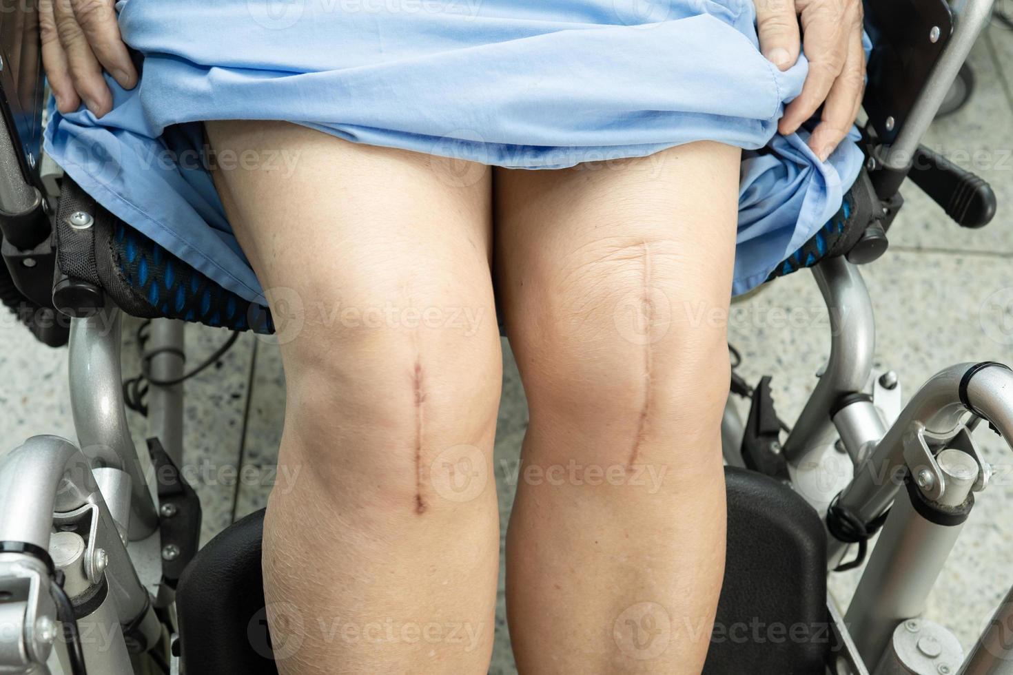 asiatisk senior kvinna patient visa hennes ärr kirurgiska totala knäleden foto