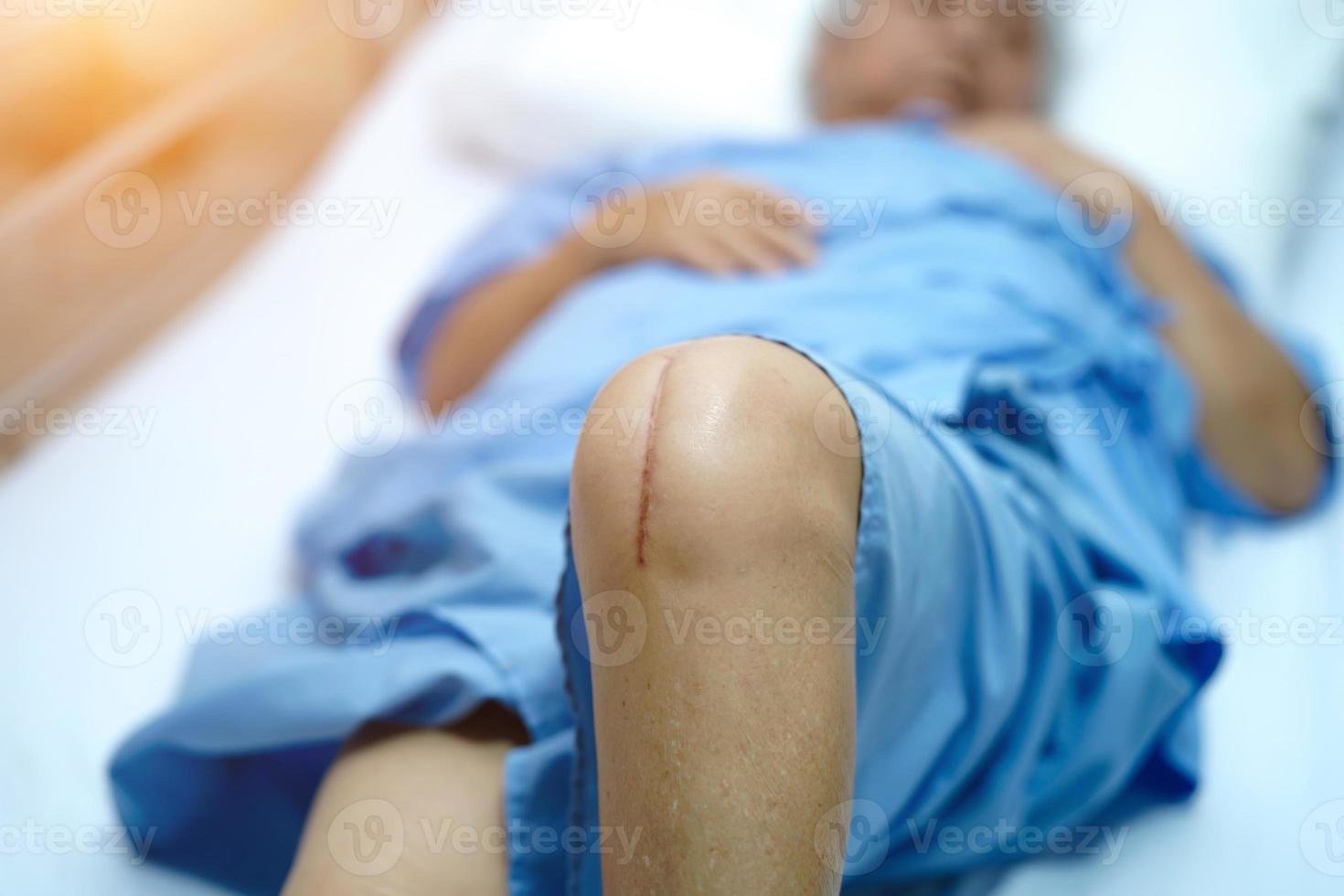 asiatisk seniorpatient visar hennes ärr kirurgiskt knäledsbyte foto