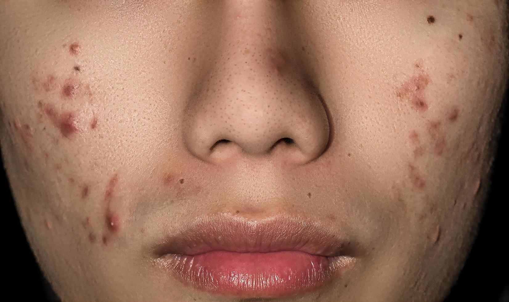 närbild av akne på huden, akne i ansiktet orsakat av hormon. foto