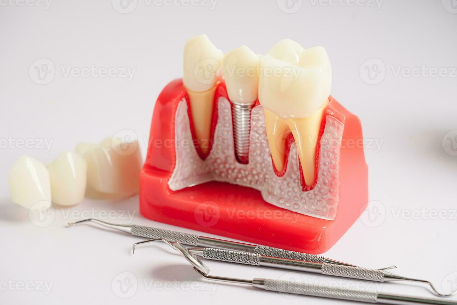 dental implantera, artificiell tand rötter in i käke, rot kanal av dental behandling, gummi sjukdom, tänder modell för tandläkare studerar handla om tandvård. foto