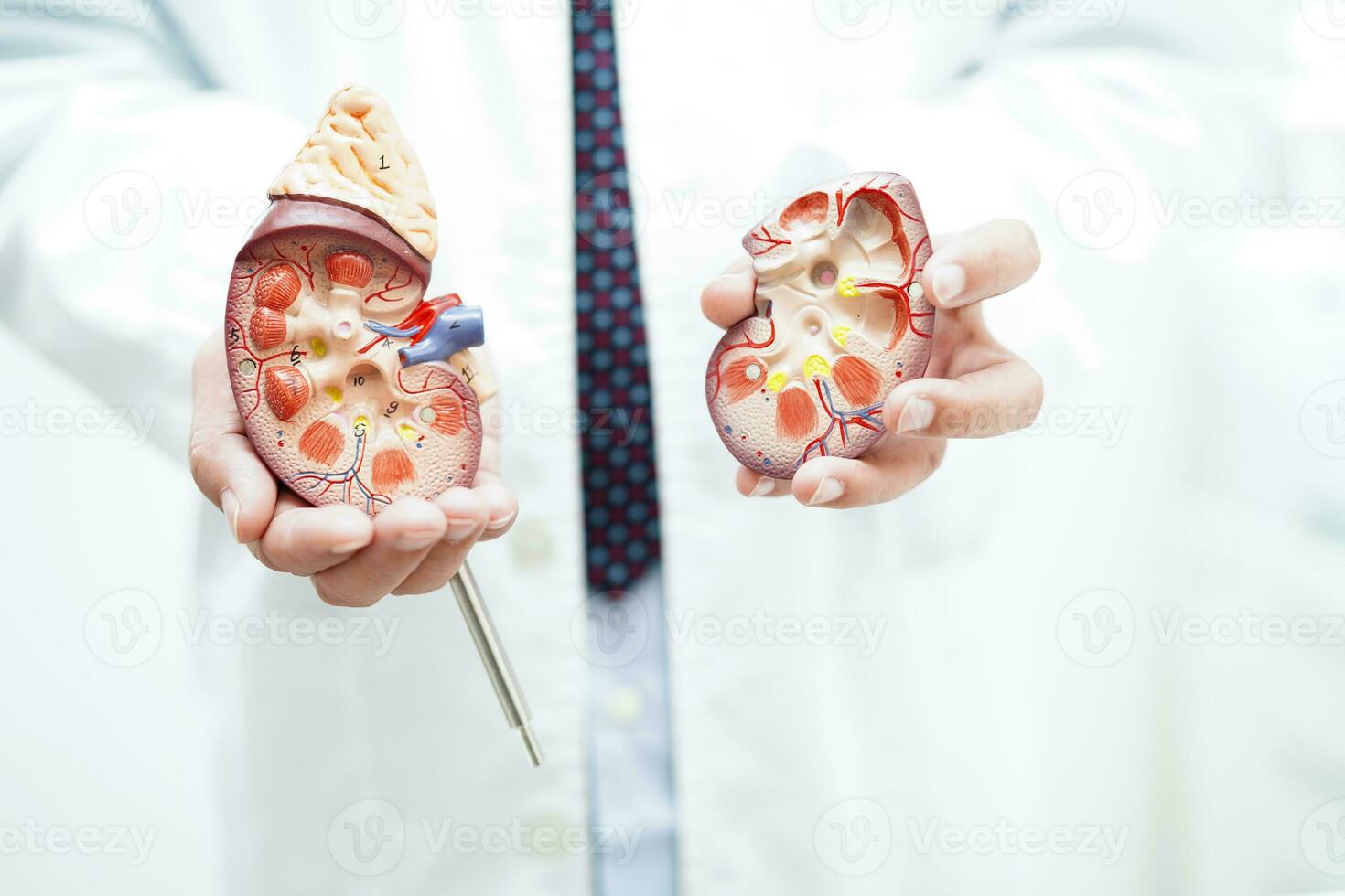 kronisk njure sjukdom, läkare med modell för behandling urin- systemet, urologi, beräknad glomerulär filtrering Betygsätta egfr. foto