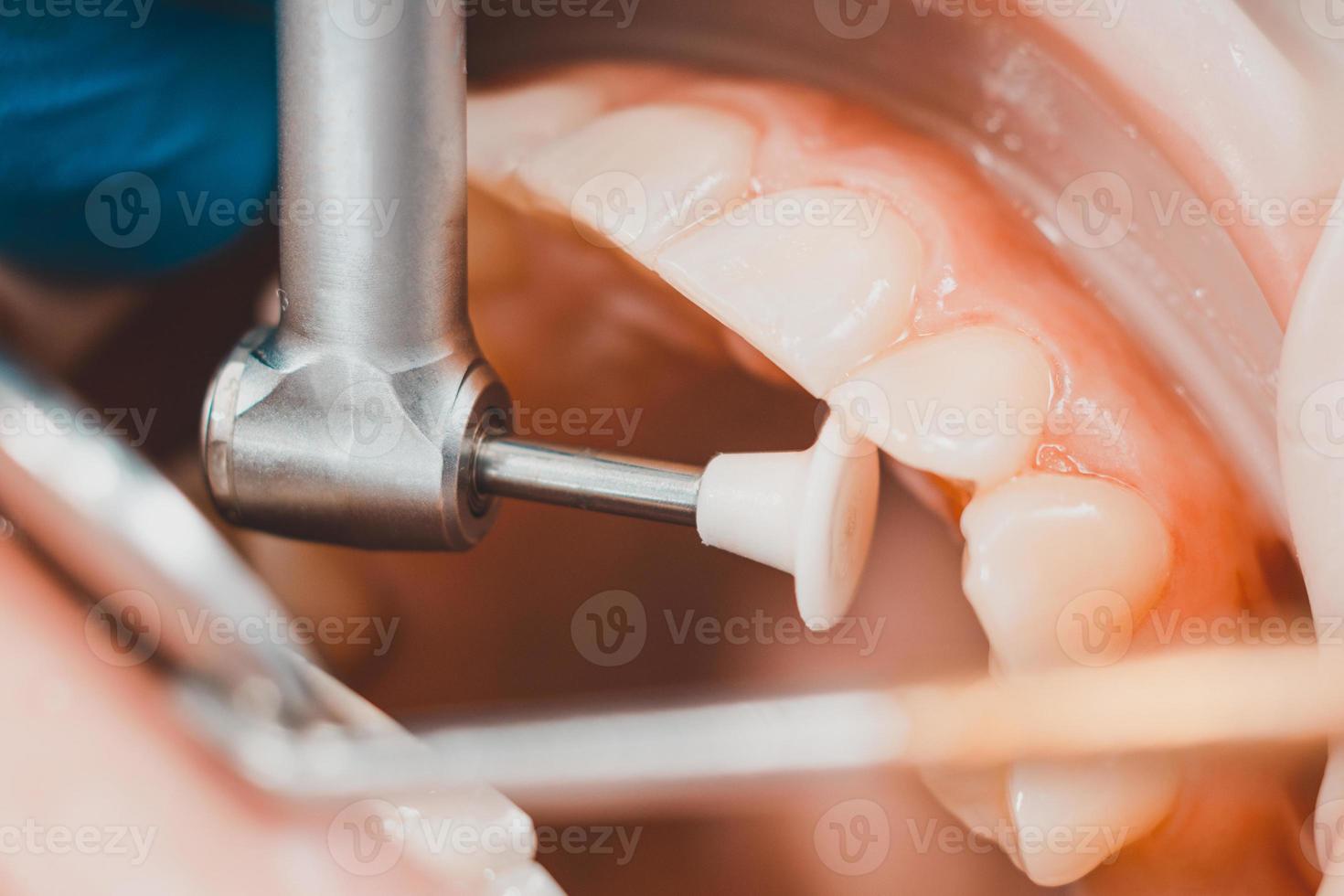 tandläkaren polerar tänderna med en borr foto