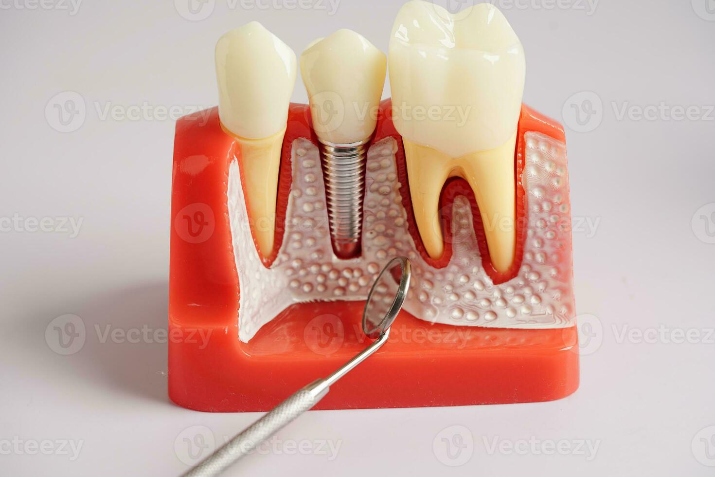 dental implantera, artificiell tand rötter in i käke, rot kanal av dental behandling, gummi sjukdom, tänder modell för tandläkare studerar handla om tandvård. foto