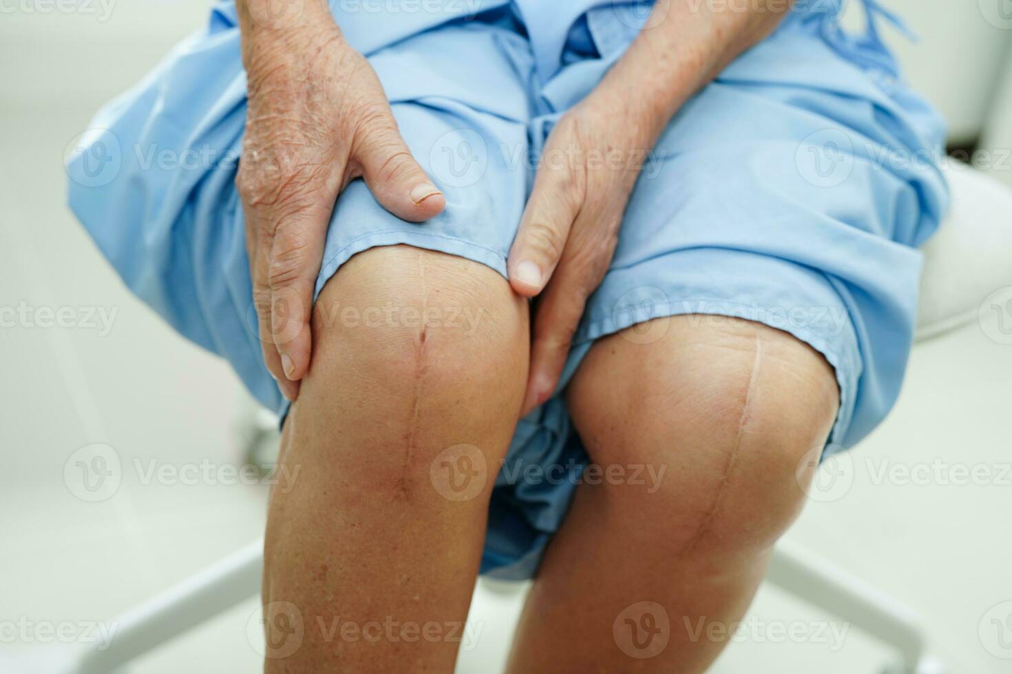 asiatisk äldre kvinna patient med ärr knäproteskirurgi på sjukhus. foto