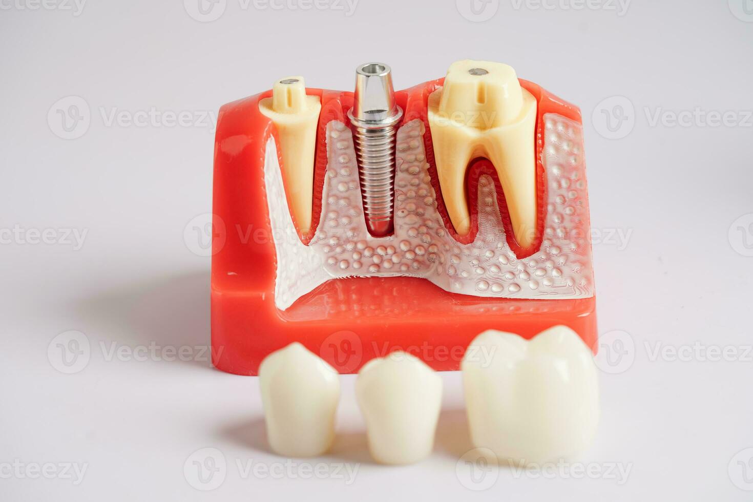 dental implantera, artificiell tand rötter in i käke, rot kanal av dental behandling, gummi sjukdom, tänder modell för tandläkare studerar handla om tandvård. foto