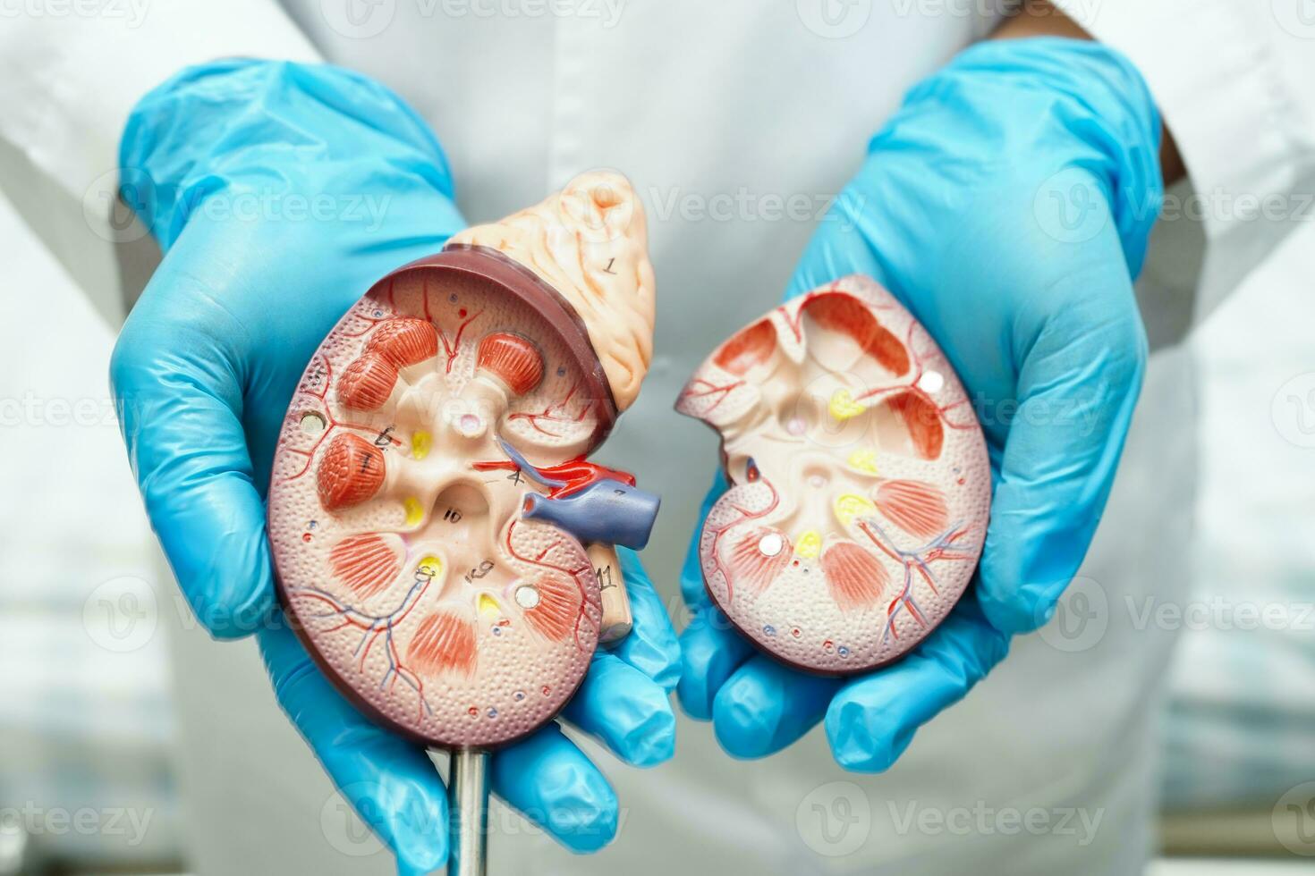 kronisk njure sjukdom, läkare med modell för behandling urin- systemet, urologi, beräknad glomerulär filtrering Betygsätta egfr. foto