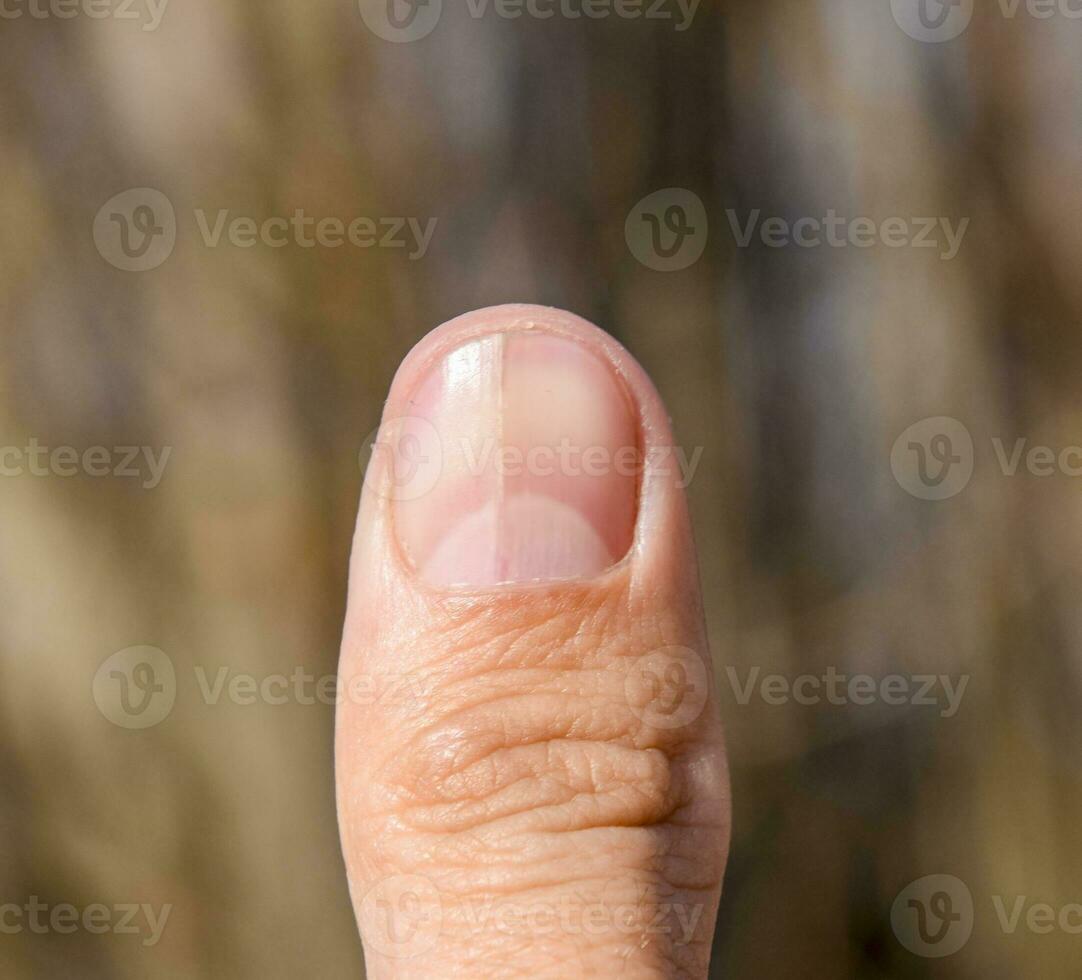 kluven nagel på de tumme. utvidgning av de nagel, traumatisk patologi. de nagel är dividerat i halv foto