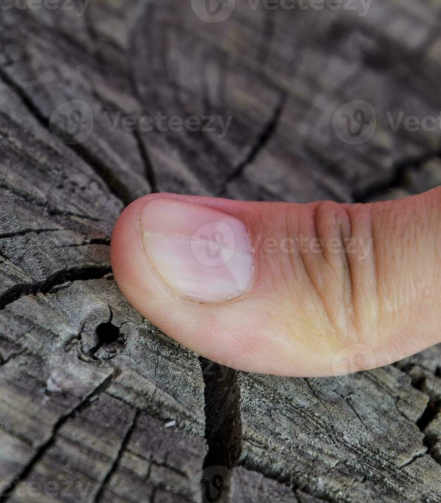 kluven nagel på de tumme. utvidgning av de nagel, traumatisk patologi. de nagel är dividerat i halv foto