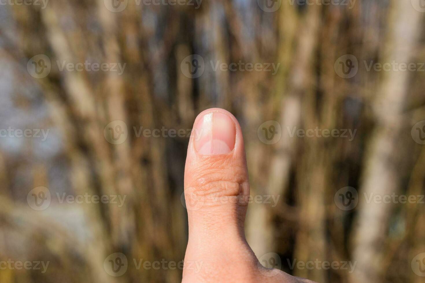 kluven nagel på de tumme. utvidgning av de nagel, traumatisk patologi. de nagel är dividerat i halv foto