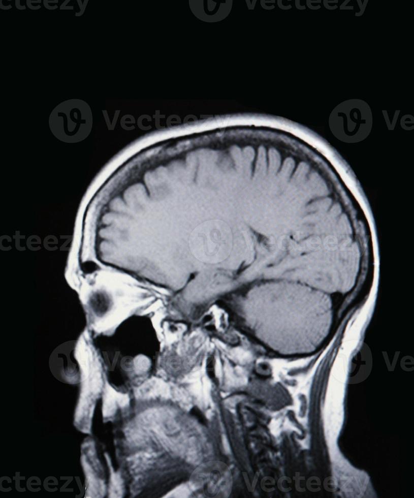 en riktig mri mra av hjärnans kärl foto