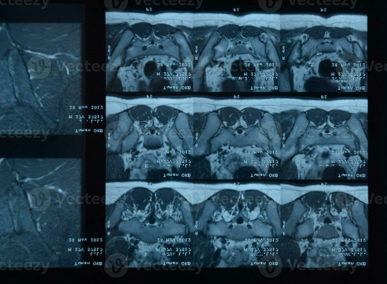 mri sacroiliac artikulation. studie av ankyloserande spondyloartrit patient. foto