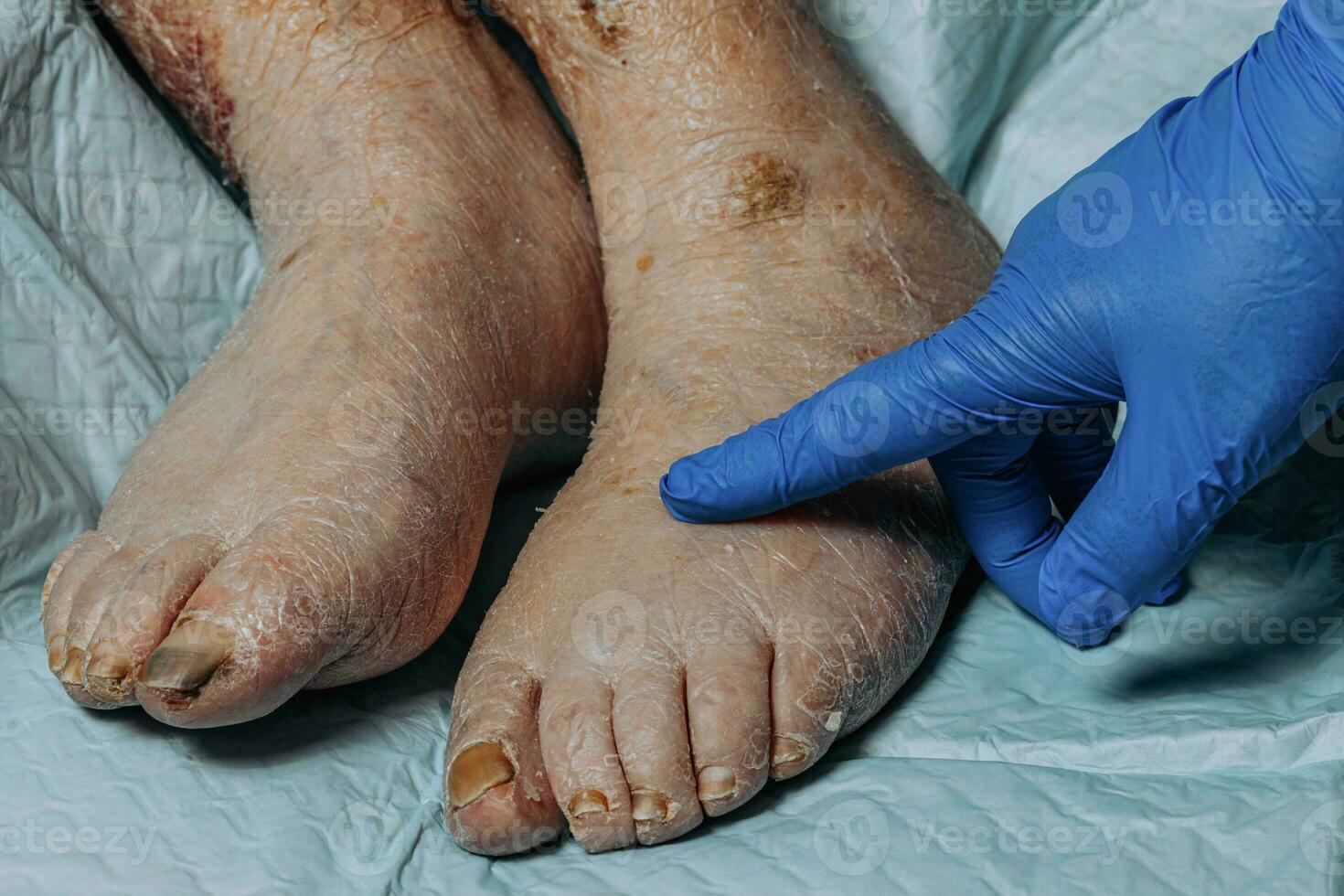 de hud på de ben av ett äldre kvinna skalar av på grund av till eksem. gulning av de nagel tallrik. svullnad av de ben. konsekvenser av diabetes i de äldre. äldre vård foto